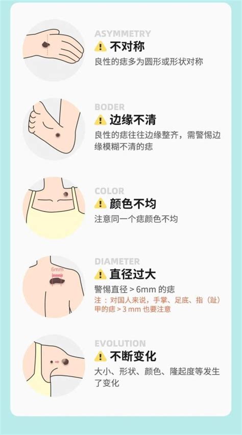 虎口突然長痣|痣也可能会癌变！长在 3 个地方要注意